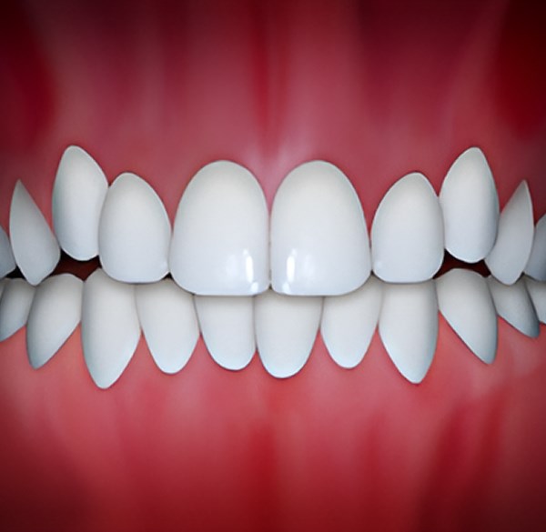 Teeth crowding treatment at Bay Tree Orthodontics in Mt. Pleasant