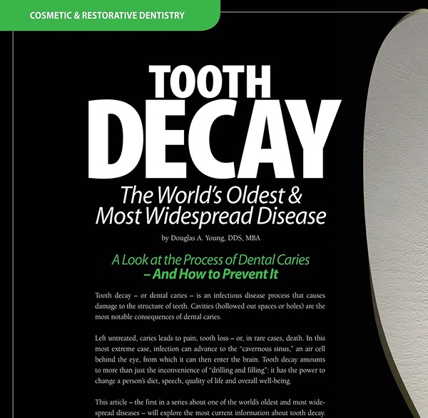 Tooth Decay — A Preventable Disease at Bay Tree Orthodontics in Mt. Pleasant