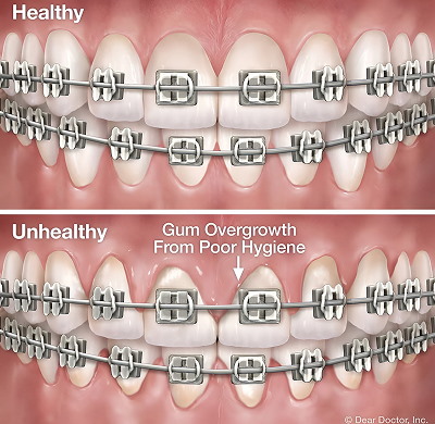 Braces types showing plaque buildup at Bay Tree Orthodontics in Mt. Pleasant